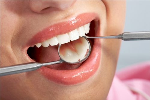 Tẩy trắng răng và những điều nên biết để tránh tiền mất tật mang-2