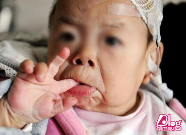 Bé gái mắc bệnh lão hóa sớm khiến em 16 tháng tuổi nhưng lại mang ngoại hình của một cụ bà 80.