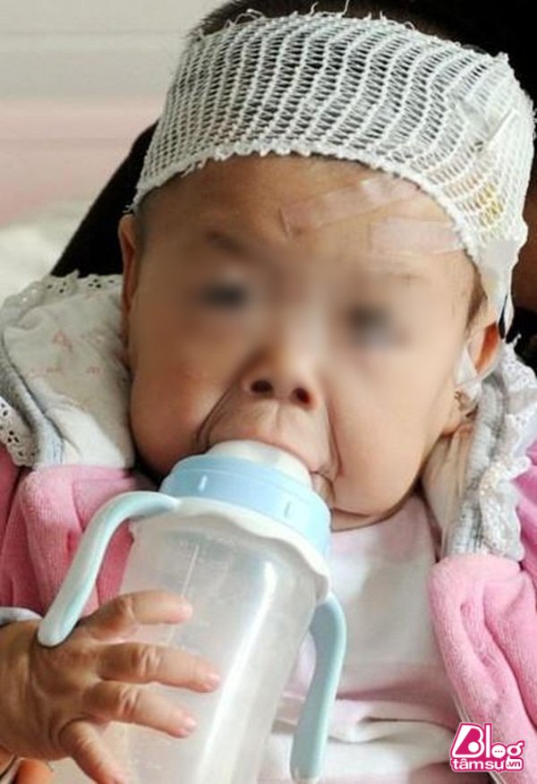 Bé gái mắc bệnh lão hóa sớm khiến em 16 tháng tuổi nhưng lại mang ngoại hình của một cụ bà 80.