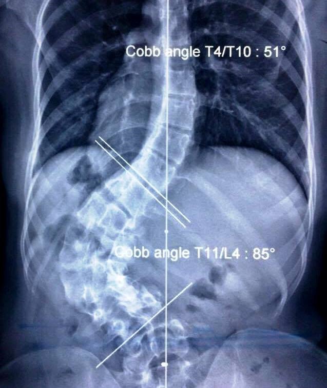 Cột sống bị cong vẹo của cô sinh viên được chụp qua X-quang. (Ảnh: Hoài Nhơn)