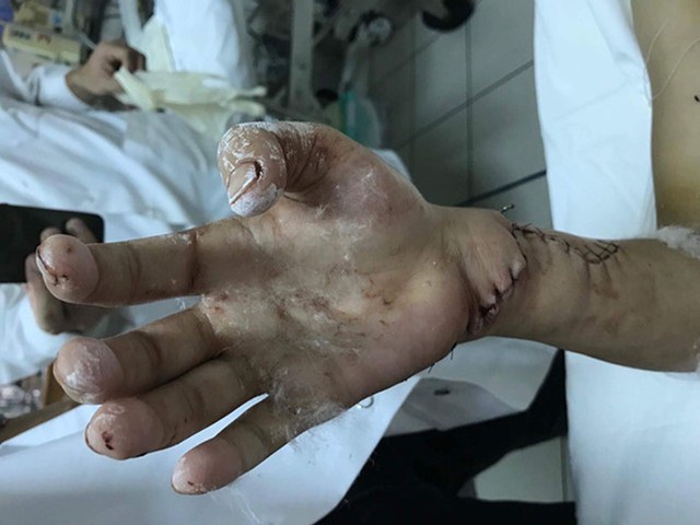 Bàn tay phải bị đứt lìa của bệnh nhân Linh được y, bác sĩ Trung tâm Chấn thương chỉnh hình, Bệnh viện Trung ương Huế nối lại thành công.