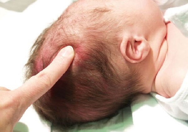 Đầu trẻ sơ sinh có sọ bất thường