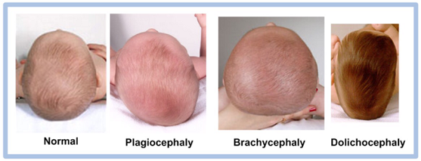 Đầu trẻ sơ sinh bình thường, bị méo một bên, bẹp phía sau, bẹp 2 bên (thứ tự từ trái sang phải)