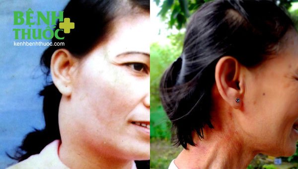 Khối u ở cổ bà Tiến năm 1991 (trái), vết sẹo khối u trên cổ bà Tiến hiện tại