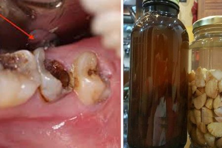 Đau răng, sâu răng, răng lung lay, ê buốt cỡ nào cũng hết nhờ bài thuốc dân gian này
